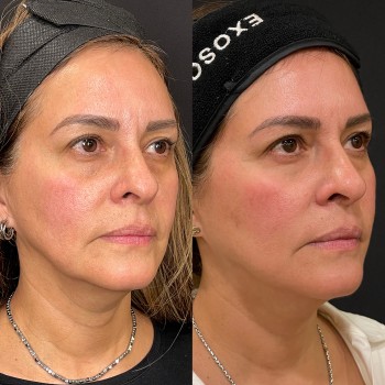 Rejuvenecimiento Facial