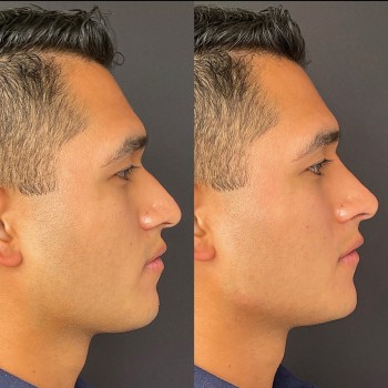 Armonización facial